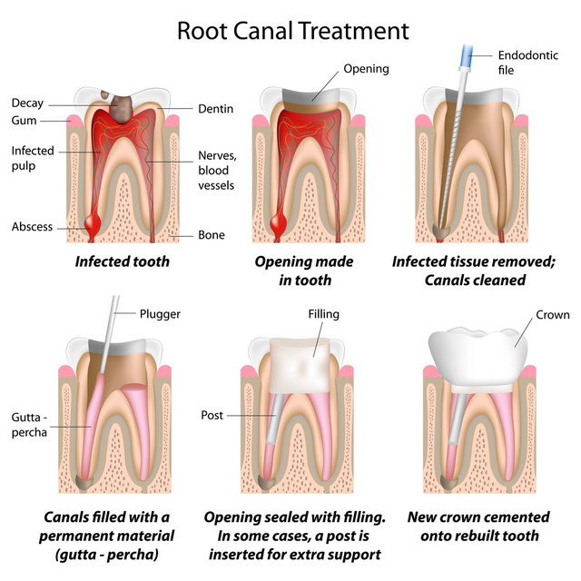 root canal revesby dental surgery