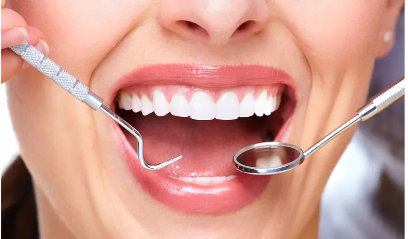 dental fillings
