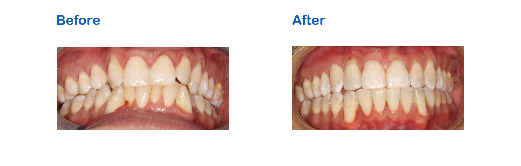 braces before and after