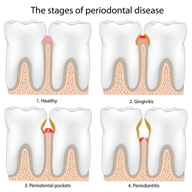 Gum Disease