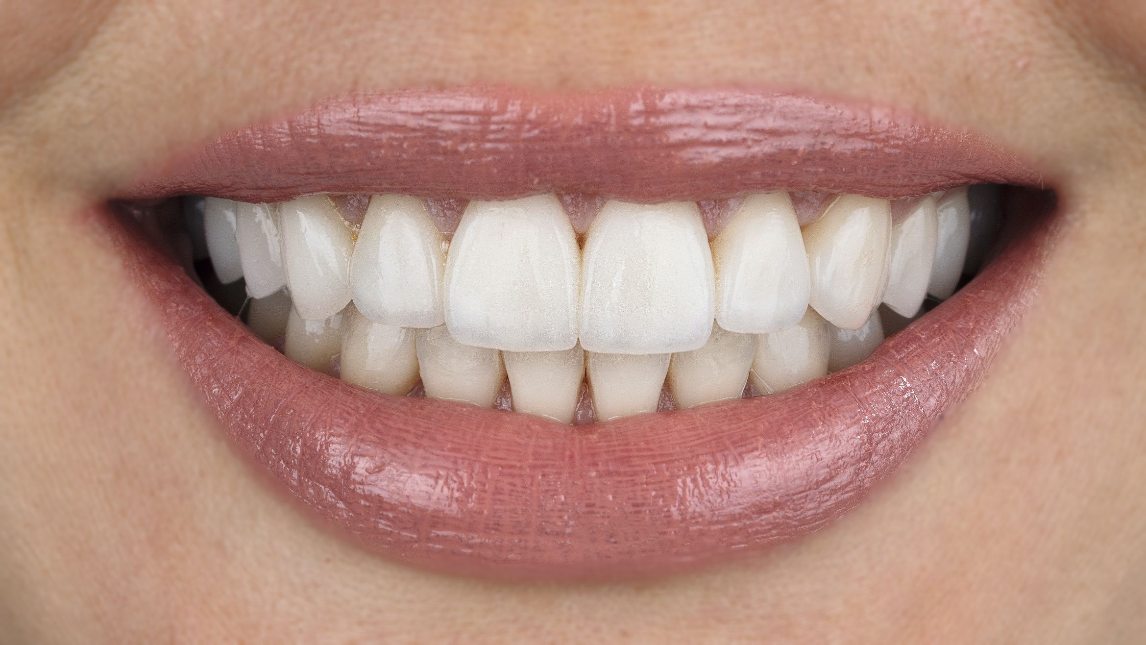 Porcelian Veneers