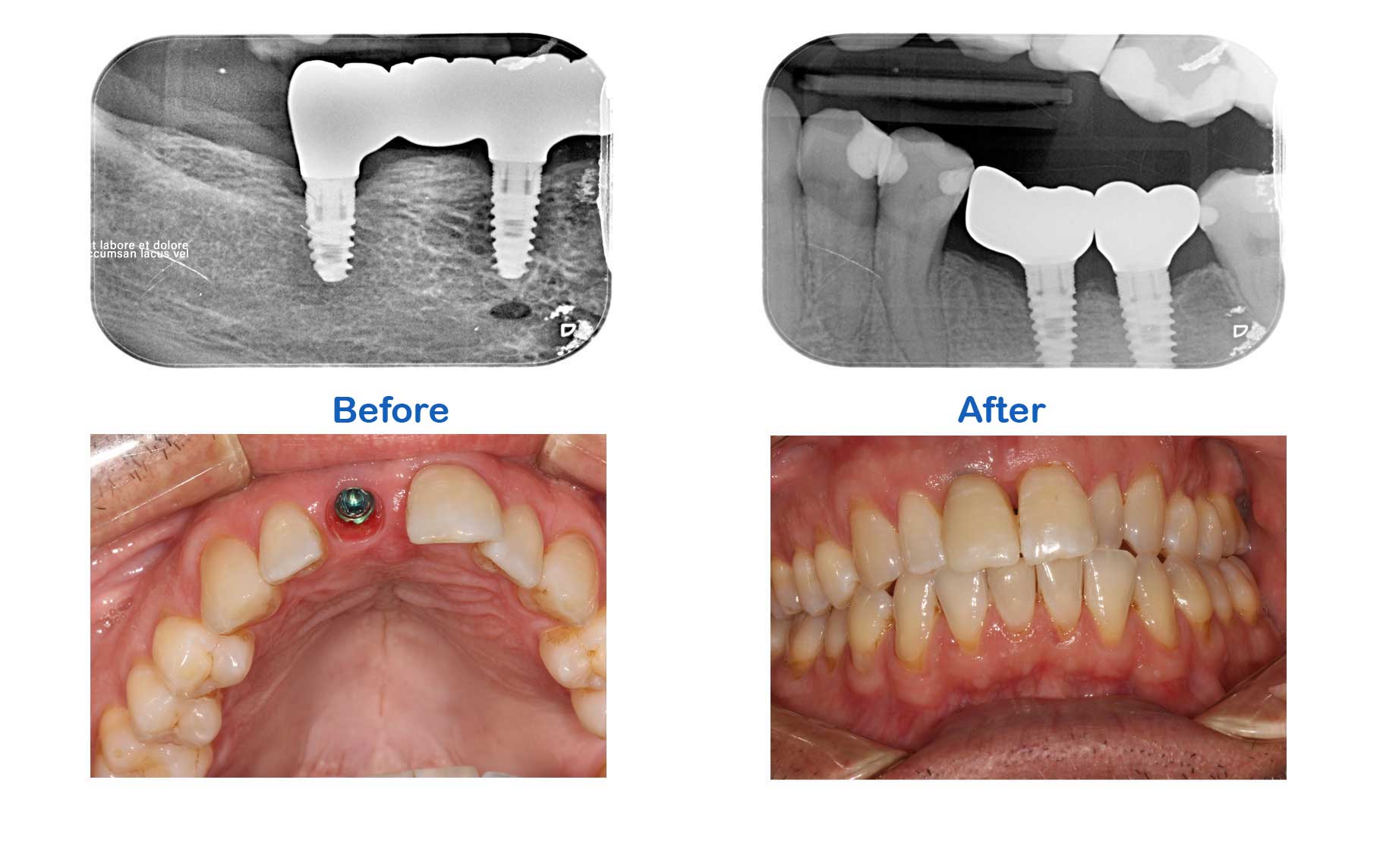 implants Before and After